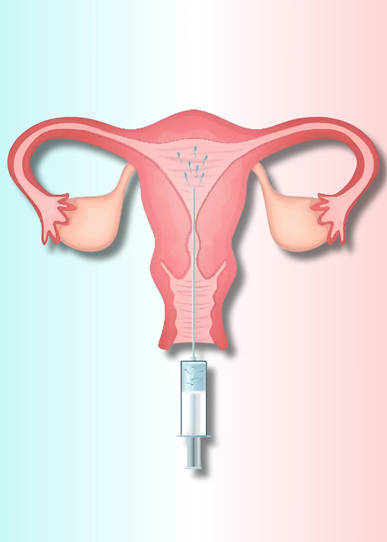 IUI Treatment